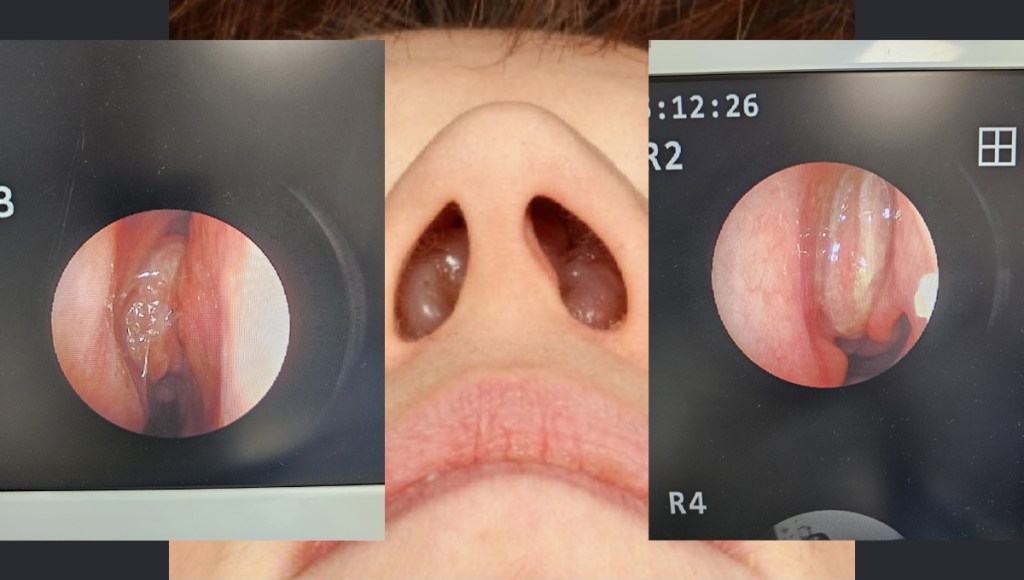Polipii Nazali: Cauze, Simptome, Diagnostic și Opțiuni Eficiente de&nbsp;Tratament